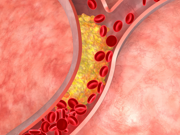 Korkean kolesterolin oireet